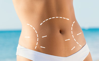 Tummy Tuck (Before And After Effects Of The Surgery And Procedure)